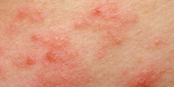 Skin Rash