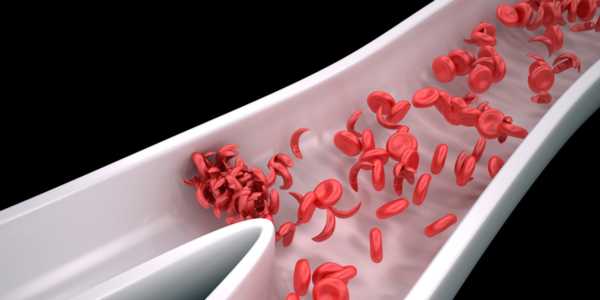 Sickle cell disease