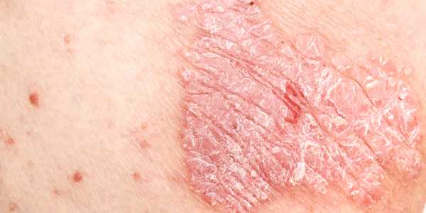 Psoriasis Arthritis