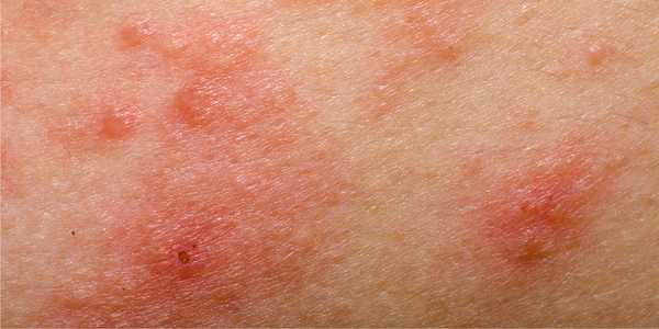 Red, Itchy Rash? Get the Skinny on Dermatitis