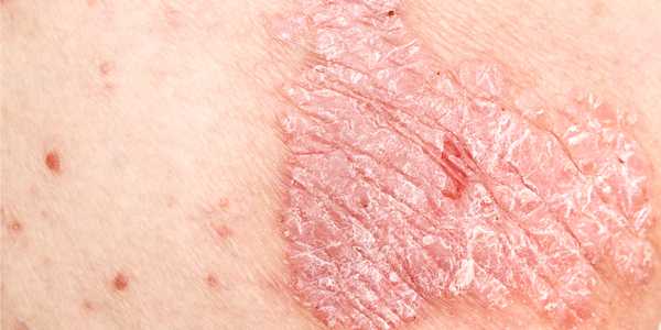 Spotlight on Psoriasis: Preventing Patches of Itchy, Sore Skin